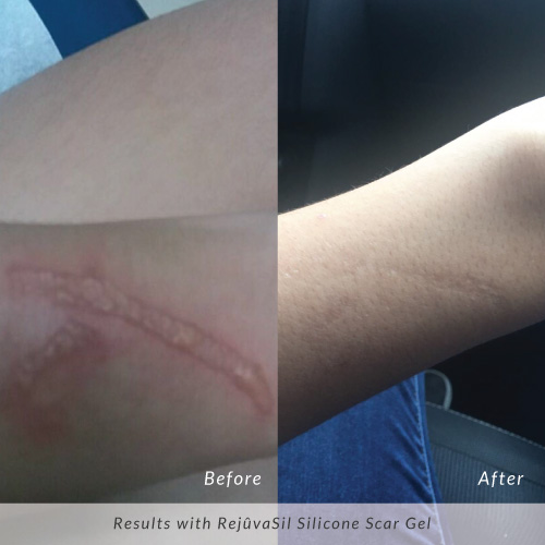 Rejuvasil-Before-and-Afer-Burn-Scar