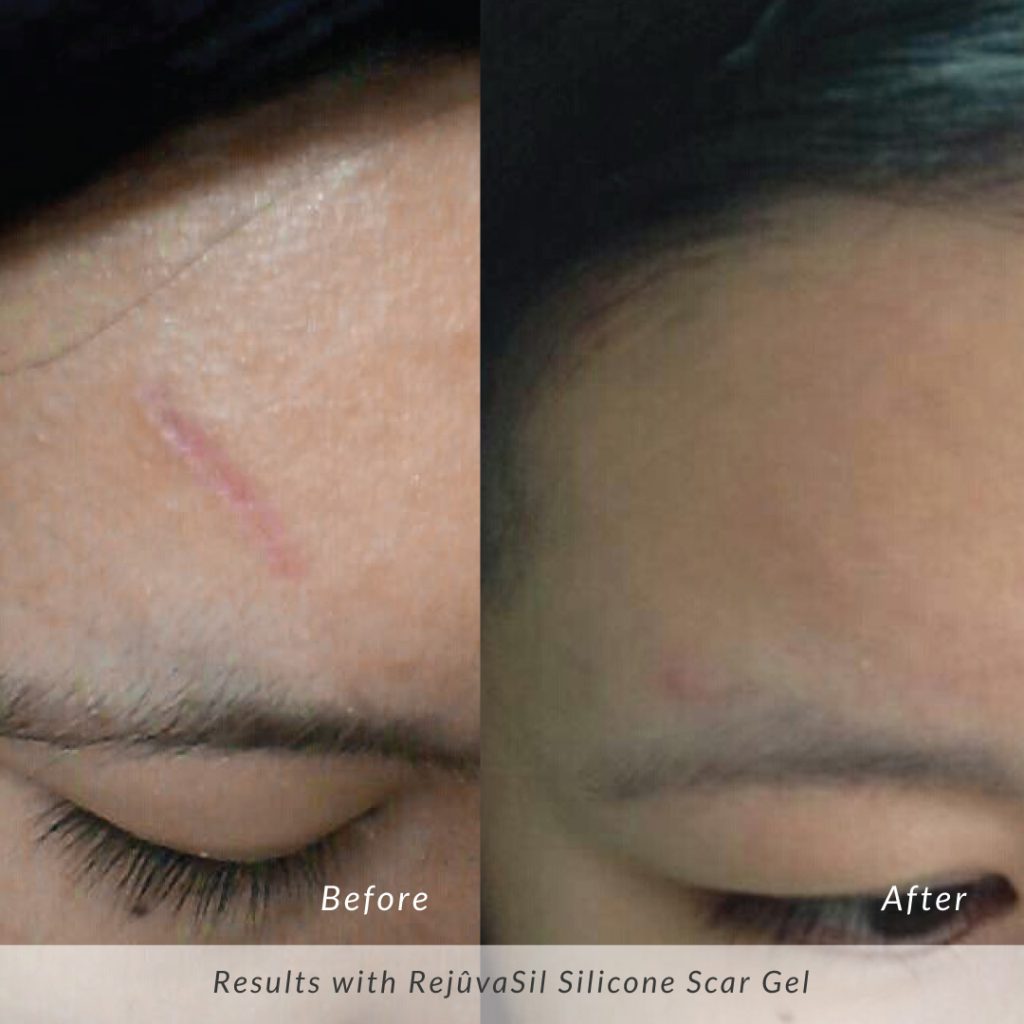 Rejuvasil-Before-and-After-Forehead-Scar