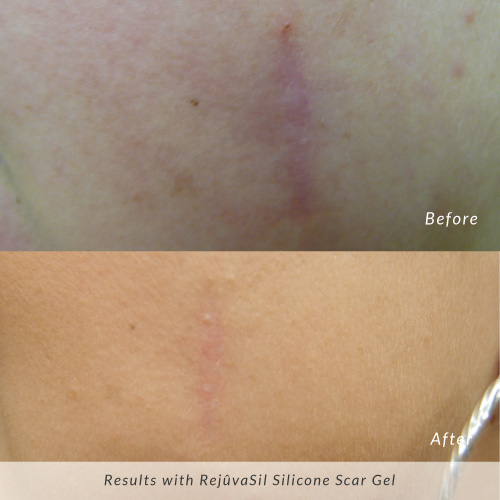 Rejuvasil-before-and-after-facial-scar