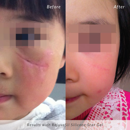 Rejvuasil-Before-and-After-Child-Facial-Scar