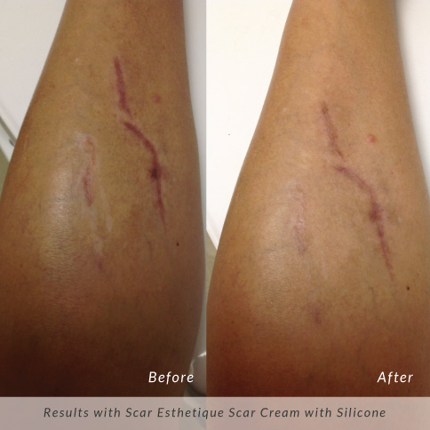 Scar-Esthetique-Before-and-After-Leg-Scar