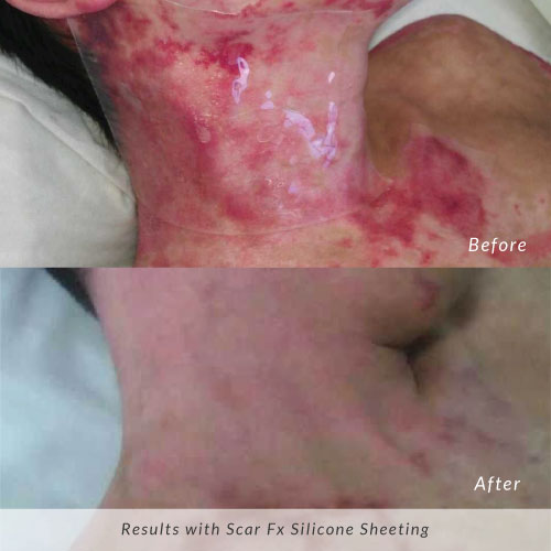 Scar-Fx-Before-and-After-Burn-Scar