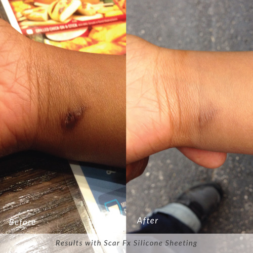 Scar-Fx-Before-and-After-Keloid-Wrist