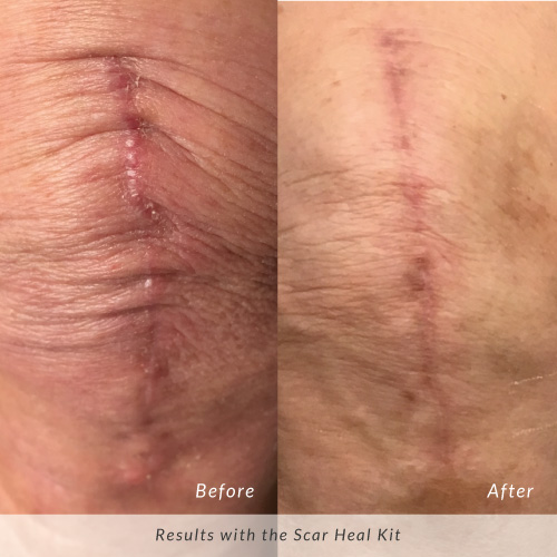 Scar-Heal-Kit-Before-and-After-Knee-Scar