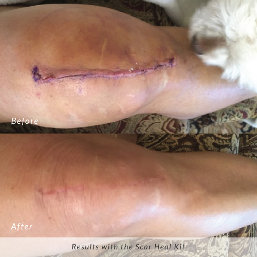 Scar-Heal-Kit-Before-and-After-Knee-Surgery