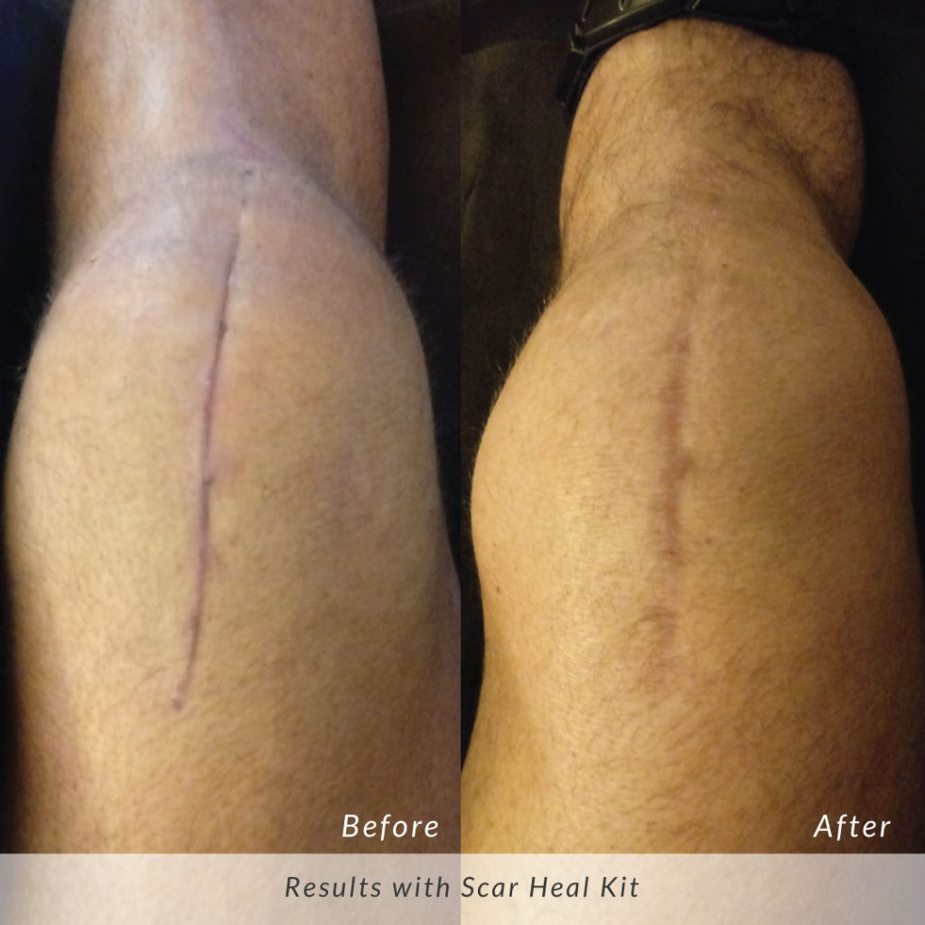Scar-Heal-Kit-Knee-Surgery