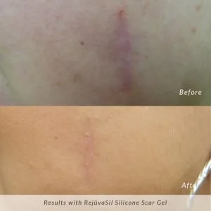 Rejuvasil-before-and-after-facial-scar-300x300
