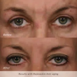 Rejuvaskin-Anti-aging-Before-and-After-300x300