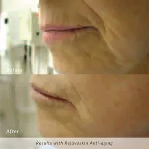 Rejuvaskin-Anti-aging-before-and-after-photo-300x300