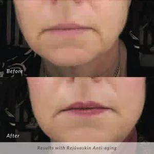 Rejuvaskin-Before-and-After-Anti-aging-300x300