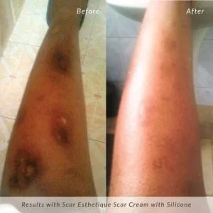 Scar-Esthetique-Before-and-After-Leg-Burn-Scar-300x300