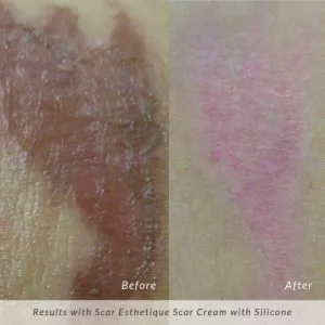 Scar-Esthetique-Before-and-After-Scar-300x300