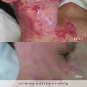 Scar-Fx-Before-and-After-Burn-Scar-300x300
