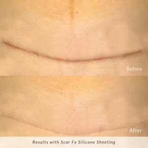 Scar-Fx-Before-and-After-C-Section-Scar-300x300