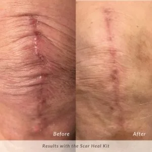Scar-Heal-Kit-Before-and-After-Knee-Scar-300x300