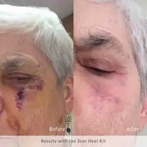 Scar-Heal-Kit-Before-and-After-Mohs-Scar-300x300