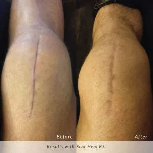 Scar-Heal-Kit-Knee-Surgery-300x300